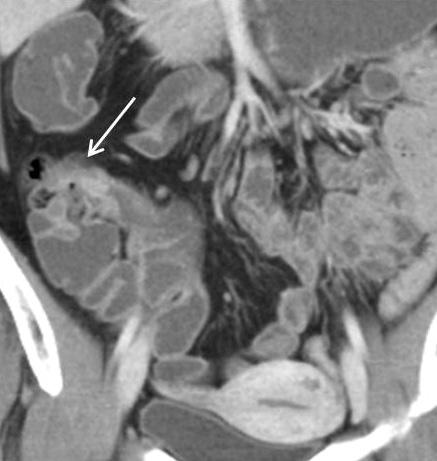 Crohn 병의진단과질병활성도, 합병증평가에있어서 CT 소장조영술의횡단영상과관상영상의유용성비교 A B C Fig. 5.