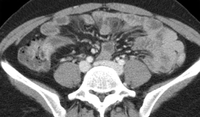 A 27-year-old woman with fibrotic stricture in Crohn disease. A-C.