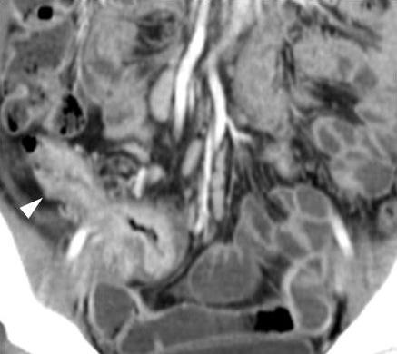 Fistula extends from the distal ileum (arrowheads) to the adjacent distal sigmoid colon (open arrows). F.