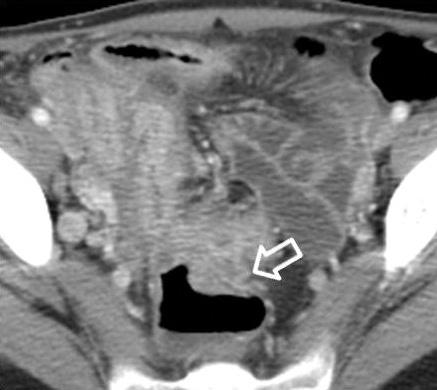 Sigmoid colon (open arrow) and rectum are seen. 었으며, 이는통계학적으로유의한차이가있었고모두 Crohn 병의만성기에나타나는소견이었다.