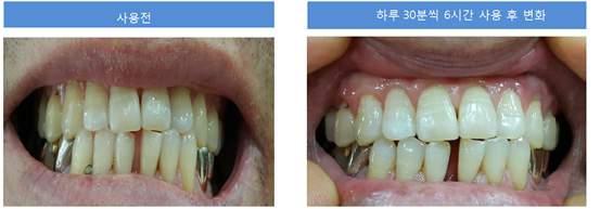특집 플라즈마응용 [Fig. 10] Tooth whitening by non-thermal atmospheric pressure plasma jet : Before (left) and after (right) treatment 러한활성산소는불안정하여전자친화성을가지며다른유기질분자와결합하여안정성을얻기위하여계속적인반응과생성함으로써미백이진행된다.