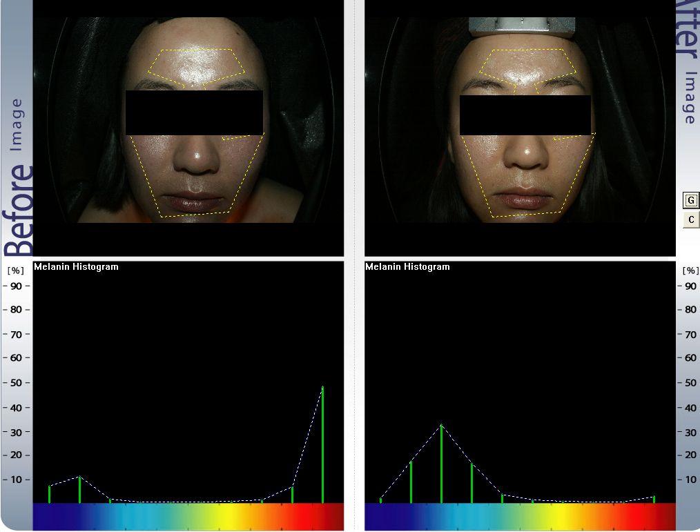 대한피부미용학회지제 7 권제 4 호 21 었고시술후푸른색으로호전되었음을알수있다. 대조군의경우도시술전과시술후그래프의변화가약간은나타났지만짧은시술기간으로인해유의한변화는관찰할수없었다.