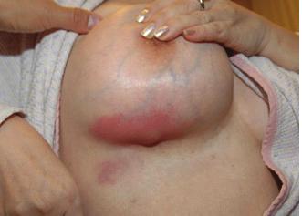 Complications of Augmentation Mammaplasty with Autologous Fat Grafts 55 방법 2006년 10 월부터 2008년 3월까지타병원에서유방확대목적으로자가지방이식을받고엠디클리닉에내원한 10 예를대상으로후향적조사를하였다.