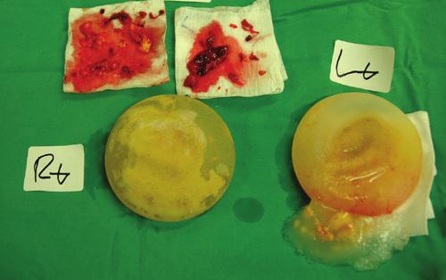 Figure 4. Punctured silicone implant with gel leakage. Figure 5.