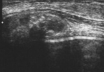 과피막을완전제거하고코히시브겔보형물로유방확대재수술을시행하였고 (Figure 4).