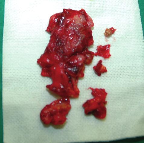 Complications of Augmentation Mammaplasty with Autologous Fat Grafts 57 Table 1.