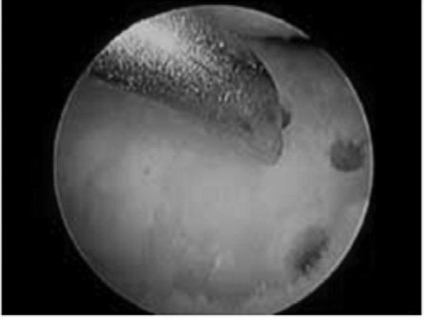 Cartilage Repair Using Mesenchymal Stem Cells A B Figure 2.