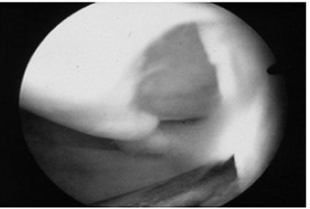52 cm), (B) 1 year after autologous chondrocytes implantation, regenerated cartilage tissue showed normal appearance