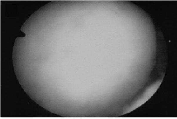 Arthroscopic view of microfracture procedure: Several holes were made on the subchondral bone with awl and each hole