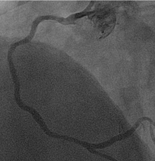 () Emergent coronary angiography shows total