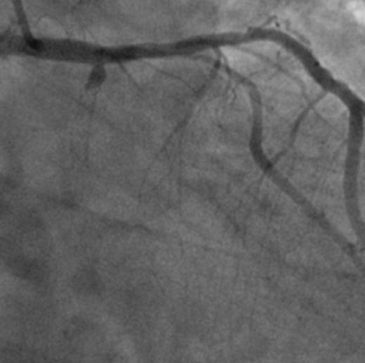 () Final angiography after balloon angioplasty shows