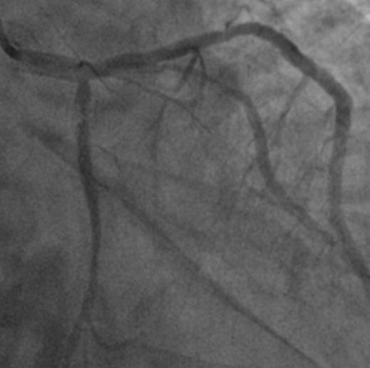 occlusion of both stents in the proximal LCX and