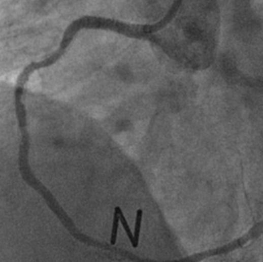 (C) Final angiography after angioplasty showed good