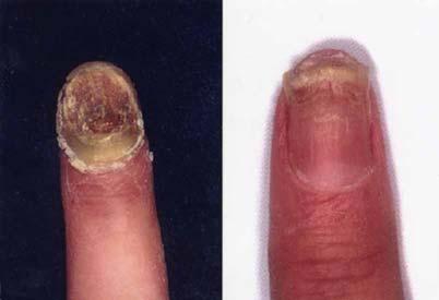 조유경등 : 당뇨환자에서발생한 Candida albicans 에의한완전이영양성조갑진균증 1 예 A B Fig. 1A. The thickened, crumbly, yellow-brownish nail plate on the right second finger in a patient with diabetes mellitus Fig. 1B.