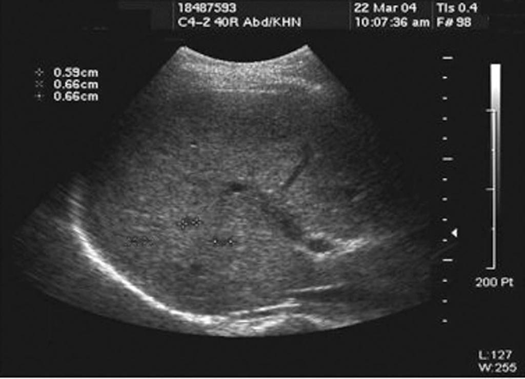 Kong Y Figure 1. A 52yearold woman complained of RUQ discomfort and cough. CBC revealed an eosinophilia of 76%. On ultrasonographic examination of the liver, approximately 0.