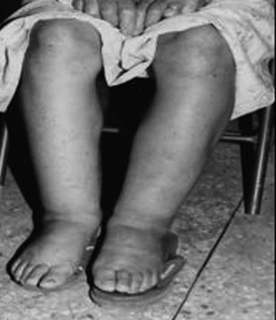 Kong Y A Figure 3. Filarial elephantiasis of the upper and lower extremities.