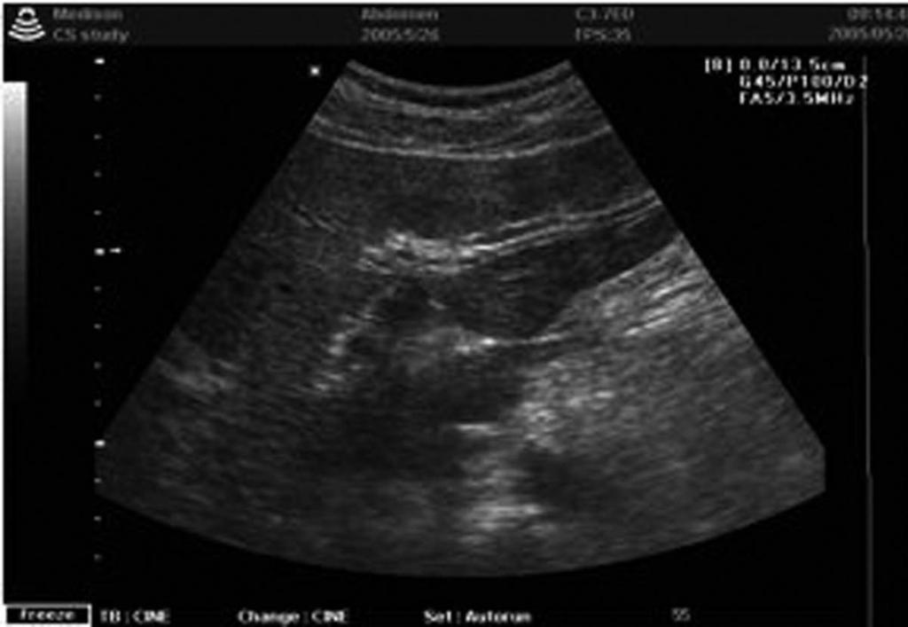 bile ducts. Note the slightly hyperechoic bands along dilated ducts, representing increased periductal echogenicity.