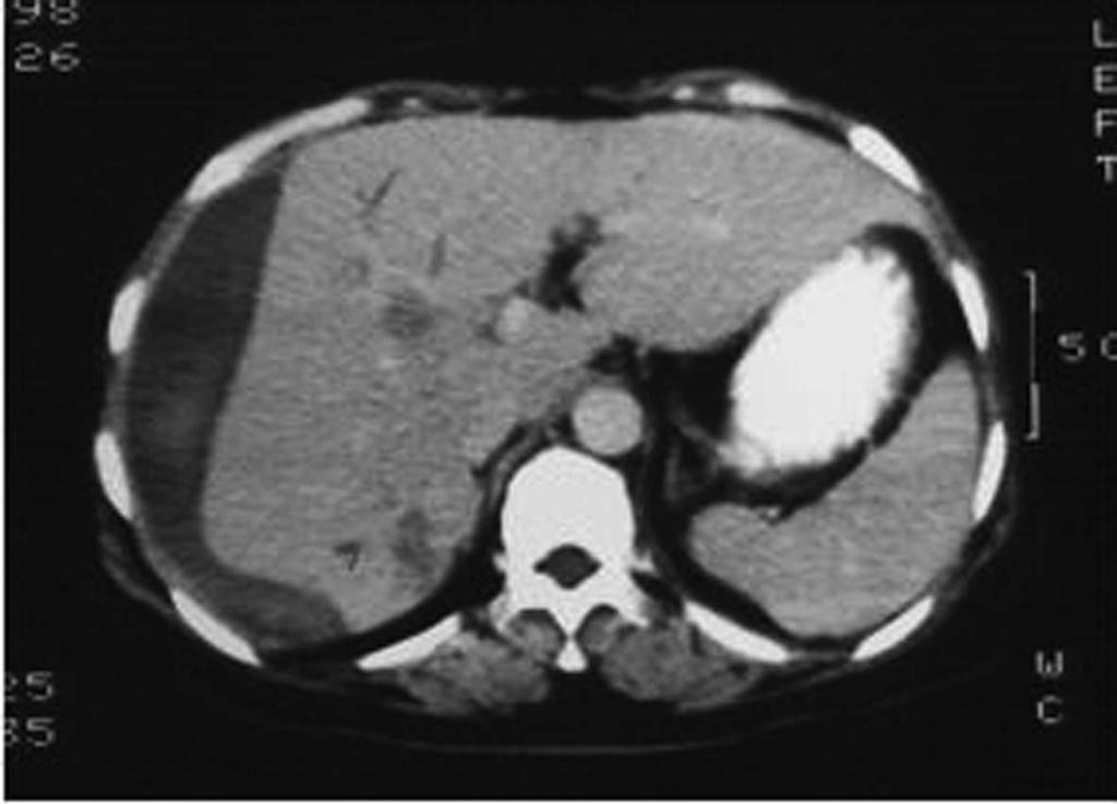 Tissue Invading Helminths Figure 6. Abdominal CT of a hepatic fascioliasis patient. Huge low density mass suggested a live abscess.