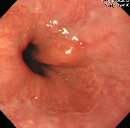 Barrett s esophagus Shape Protruding in many cases Flat elevated in many cases