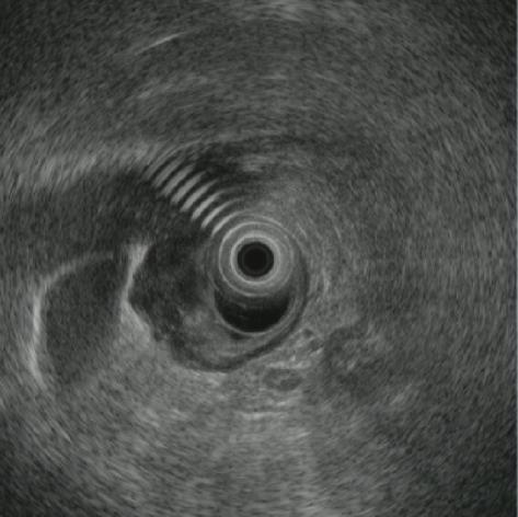 diagnosis from GIST EUS CT AGC: disrupted