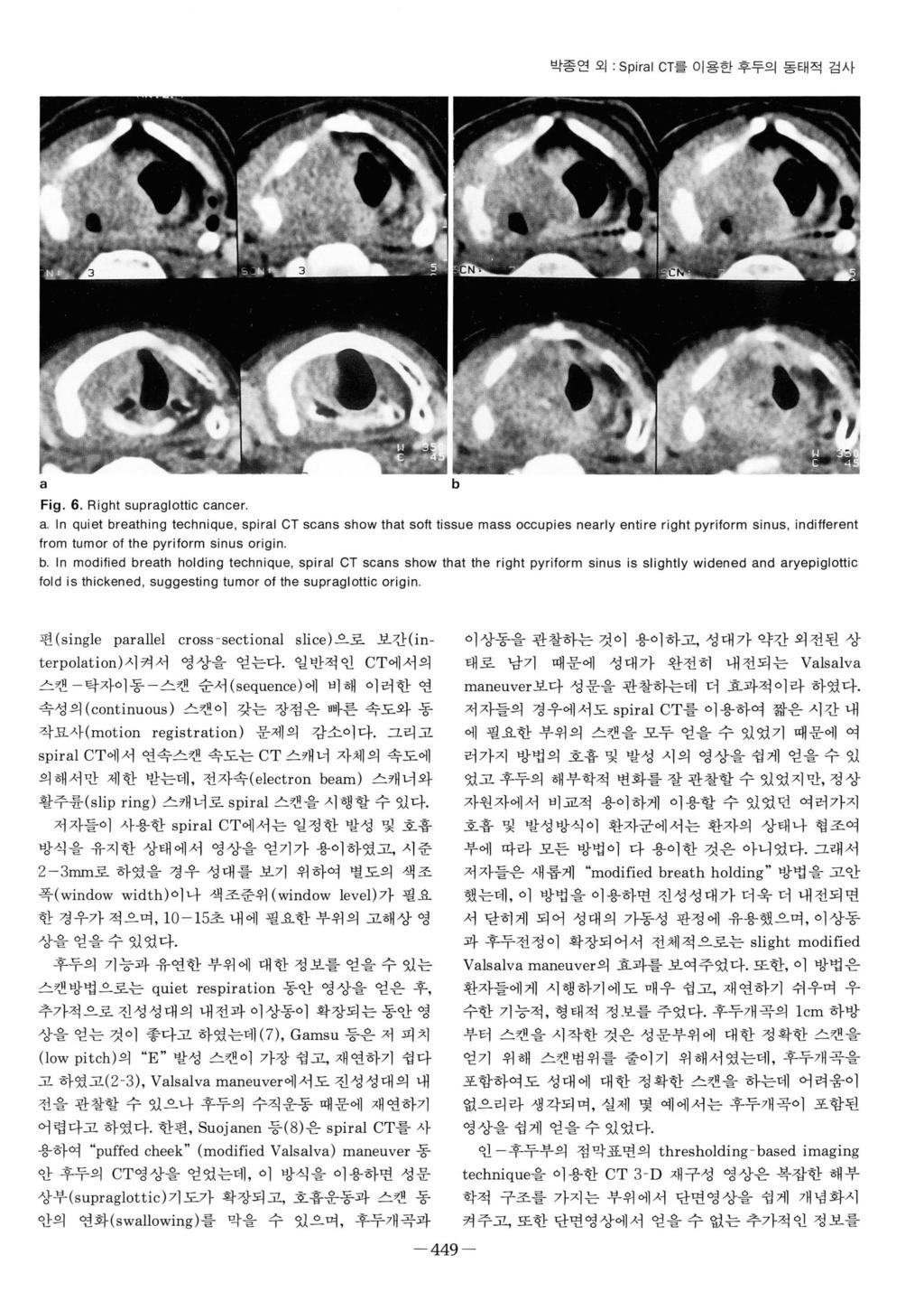 박종연외 : Spirl CT 를이용한후두의동태적검사 Fig. 6. Right suprglottic cncer.