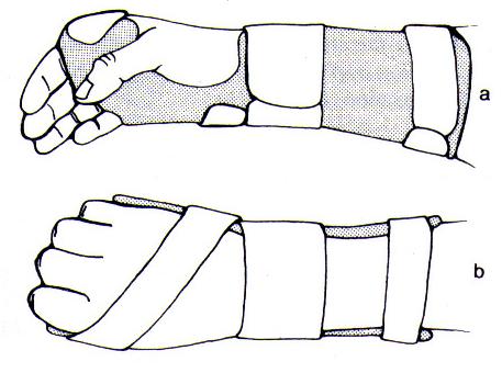 Volar Forearm-Based Static Wrist and D2-5 MP Stabilizing Orthosis Common Name: