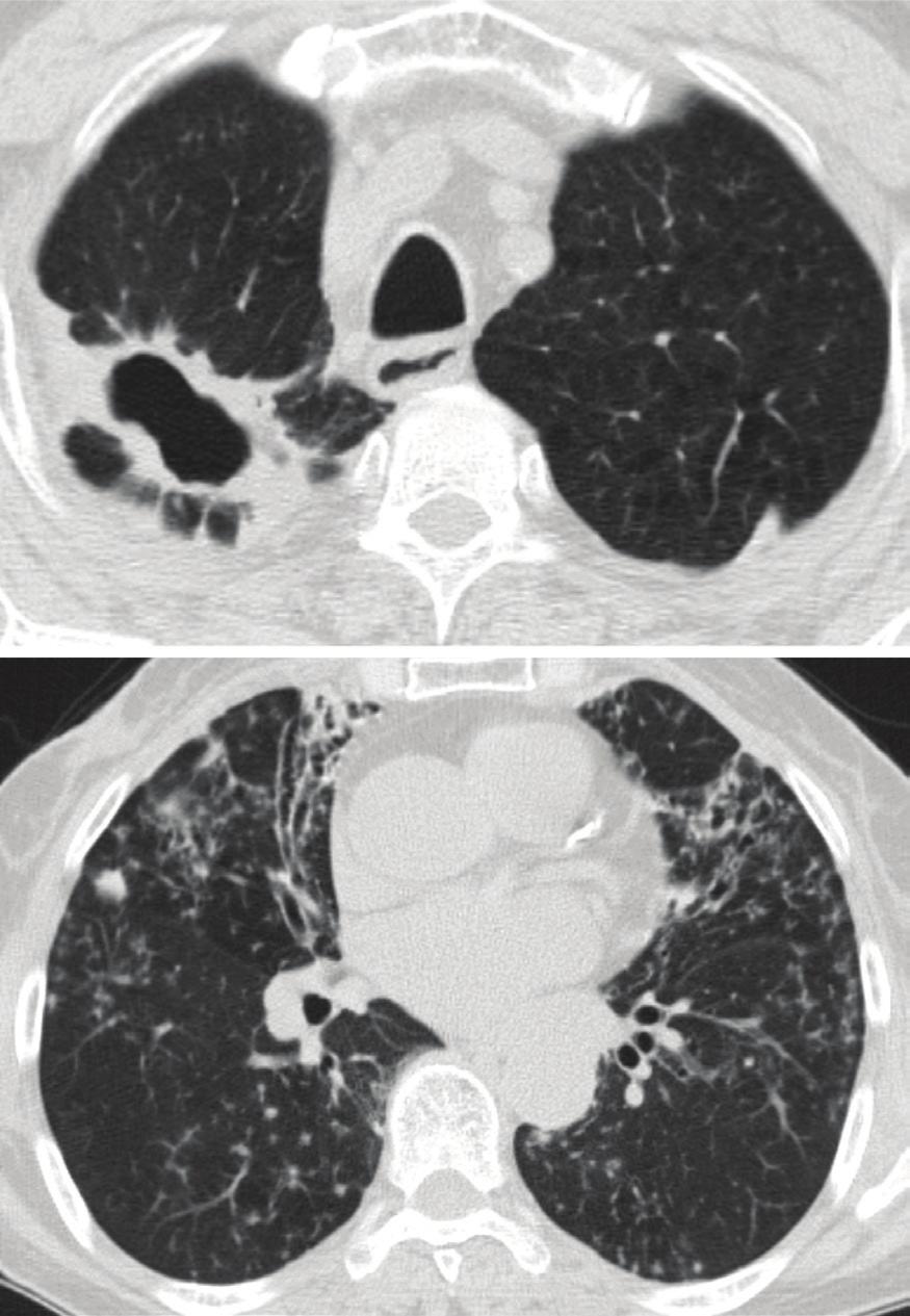 Nontuberculous mycobacterial lung disease 의학강좌 원인균을확실히규명하지않고경험적인치료를시작해서 는안된다. NTM 폐질환의치료 Figure 1.