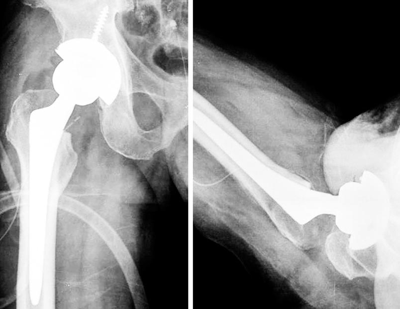 큰대퇴골두를사용하는경우작은대퇴골두에비해탈구가일어나기위해서는더많은거리의전이 Fig. 1. Plain radiograph of a 65-year-old man shows the advanced osteoarthritis in right hip.