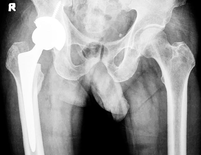 Myung-Rae Cho et al.: Total Hip Arthroplasty Using a Large Femoral Head: The Short-Term Follow-up Results and the Early Complications Fig. 3. A dislocation developed at postoperative 11 days.