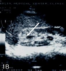 Magnetic resonance cholangiopancreatography showing a pancreatic head mass (5 cm sized) with duct dilatation. 장의두부에 6.