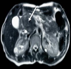 Magnetic resonance cholangiopancreatography (MRCP) 상췌장두부에췌관의확장을동반한약 5 cm 크기의이질성종괴가관찰되었다 (Fig. 4). 뇌전산화단층촬영은시행하지못하였다.