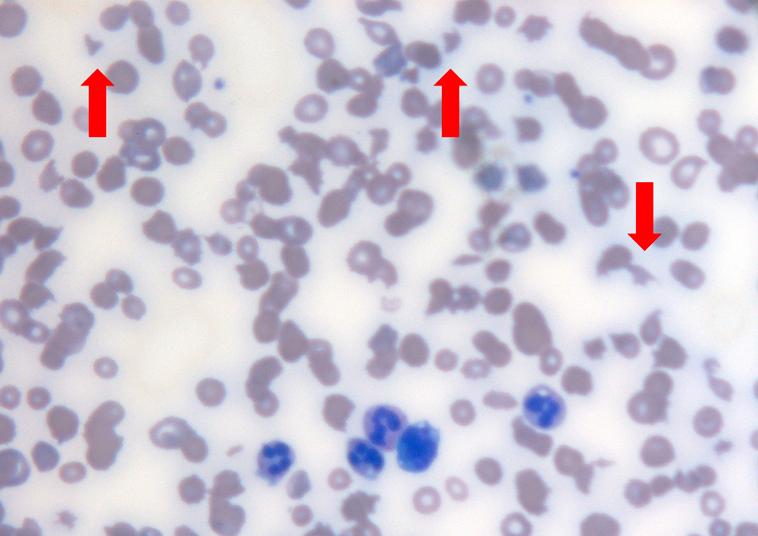 YJ Park et al: A case of HUS in a patient treatet with Gemcitabine Figure 1. Peripheral blood smear showed schistocytes ( 400). 항암화학치료를 시행받았으나 안정 병변(stable disease) 상태로 판단되어 약물변경을 고려 중이었다.