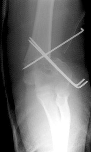18 심종섭ㆍ설은진ㆍ하해찬외 1 인 Fig. 1. (A) Lateral closing wedge osteotomy was performed. (B) Lazy 'S' deformity was observed on the radiograph of two months after the operation. Fig. 2.