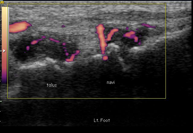 - The Korean Journal of Medicine: Vol. 89, No. 6, 2015 - A B Figure 1. Gray-scale and Doppler ultrasound findings of the tarsal (talonavicular and naviculocuneiform) joint.
