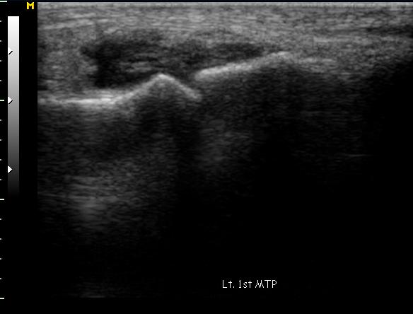 - Tae Young Kang. Ultrasound in rheumatoid arthritis - A B Figure 2. Gray-scale ultrasound findings of the carpus (A) and 1st metatarsophalangeal joint (B).
