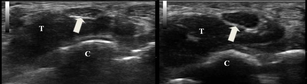 압박신경병증에서초음파검사의유용성 Figure 1. On the left is a cross-sectional view of the median nerve (arrow) at the distal wrist crease in a healthy volunteer.