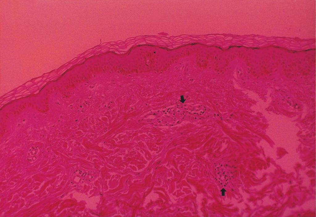 372 6 3 2000 Figure 3. Mild perivascular mononuclear cell infiltration in skin biopsy (H&E, 40) Fig ure 4.
