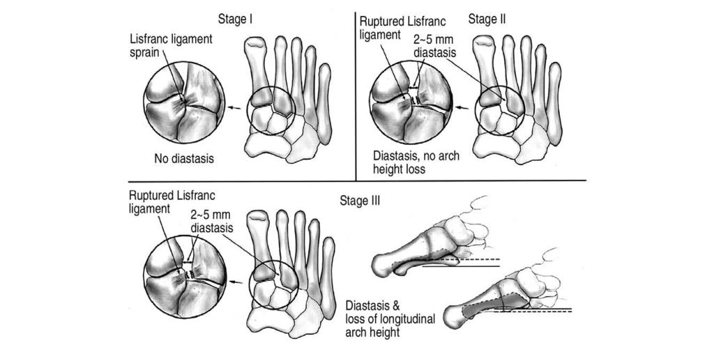 중족 - 족근관절의손상 상적인특징들을숙지해야한다 (Fig. 4). 17,18) 1 전-후면과사면사진에서제1 중족골의외측, 내측연은내측설상골의외측, 내측연과일치한다. 2 전-후면과사면사진에서제1, 2 중족골의간격은내측-중간설상골의간격과일치한다. 3 전-후면사진에서제2 중족골의내측연은중간설상골의내측연과일치한다.