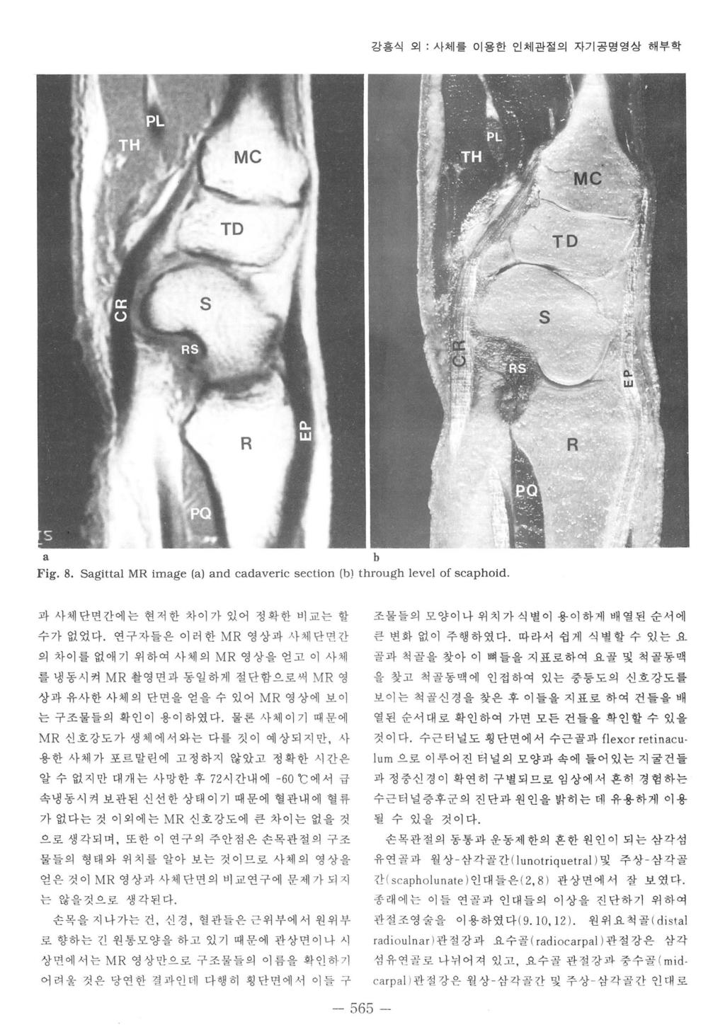 강흥식외 사체를이용한인체관절의자기공명영상해부학 Fig. 8. Sgittl MR imge () nd cdveric section () through levei of scphoid 과사체단연간에는현저한차이가있어정확한비교는할수가없었다.