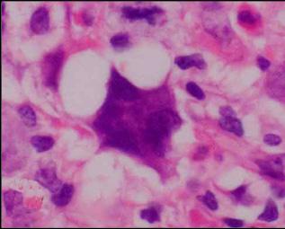 의중간형태의분류미상 B세포림프종과연관된질환으로밝혀지고있다 [11,12,21,22]. 종양세포인 Reed-Sternberg 세포와그변형 (Fig.