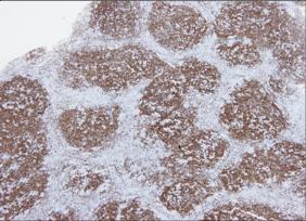 소림프구로주로구성된배경내에극소수의 RS세포가흩어져있는형으로, 과거엔흔히결절성림프구풍부성호지킨림프종 (NLPHL) 으로분류되었다 [21].