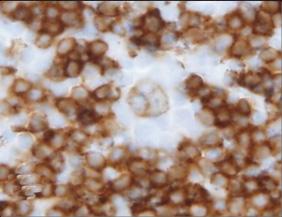 종양세포를 T세포가둘러싸서, CD20 면역염색시, 소포의외투가좀먹은듯이보이며, 이들 T세포는결절형림프구풍부형 (NLPHL) 과달리 CD57이나 PD1 등의소포T 세포항원을발현하지않는다.