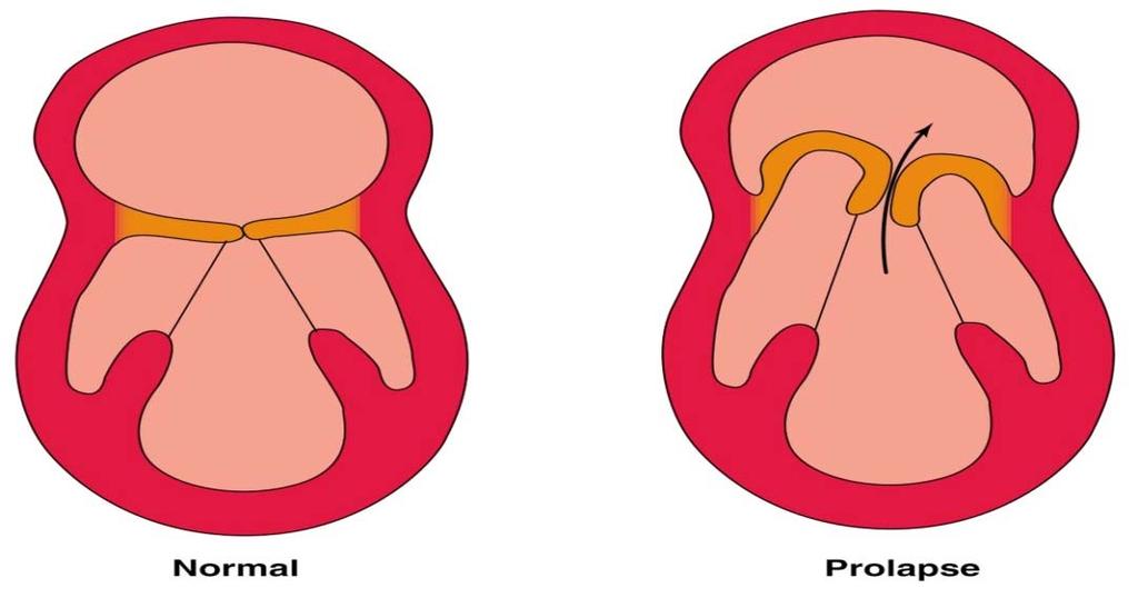 판막성심장병 (4 of 9) 승모판탈출증 (mitral valve prolapse) 소수의사람에게서문제발생