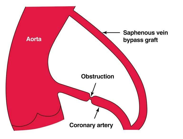 Myocardial Revascularization Procedures Bypass Surgery