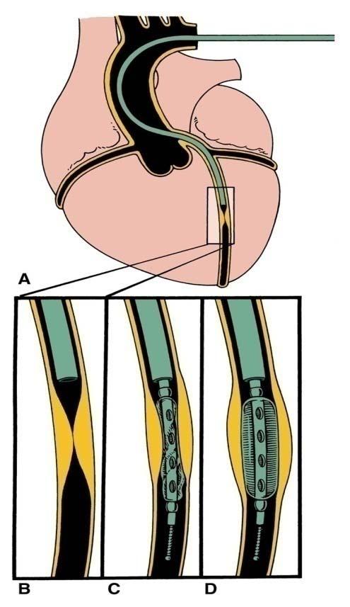 artieries to bypass obstruction Coronary Angioplasty