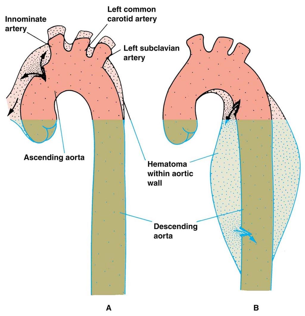 Sites of Aortic Dissection A: Tear in