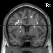 8 이연구의저자들은감정적우울은중뇌에서봉선핵 (raphe nucleus) 에이르는세로토닌계경로 (serotonergic pathway) 가, 무관심우울은흑색질 (substantia nigra) 에서중뇌의복부피개핵 (ventral tegmental nucleus) 에이르는도파민계경로 (dopaminergic pathway)
