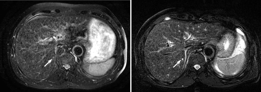 Rha SE A B Figure 1. Comparison of T2-weighted fast spin echo images obtained with 1.5 tesla (T) (A) and 3T (B) systems in the same patient.