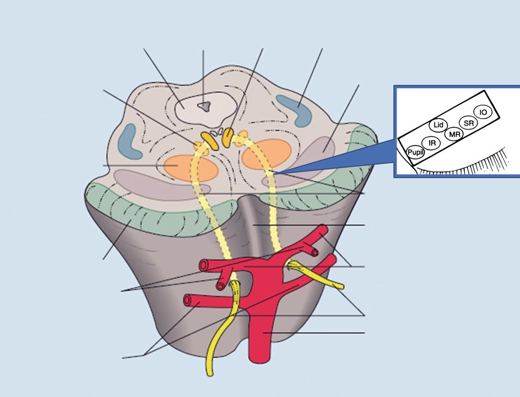 피질척수로가 침범되어 반대 베스트팔핵(Edinger-Westphal nucleus)과 후하방에 위치한 중심꼬리 측 편마비가 동반되면 Weber syndrome이라 하며, 위소뇌다리를 침범 핵(central caudal nucleus)은 중앙에서 하나의 핵이 양측을 지배한다 하여 반대편의 운동실조가 동반되면 Claude s syndrome이라고 한다.