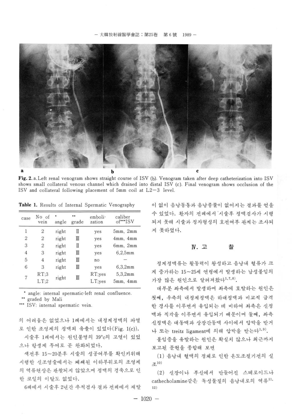 - 大韓放射線뿔學용註 : 第 5 卷 第 6 號 1989 a b C Fig.. a. Left renal venogram shows straight course of ISV (b).